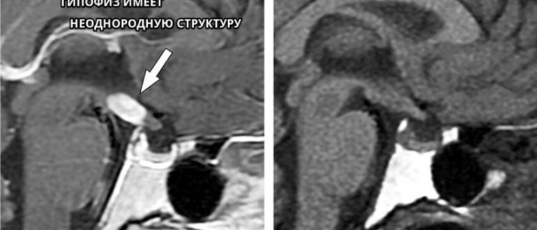 МР картина диффузно неоднородной структуры аденогипофиза
