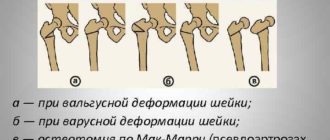 Вальгусная деформация проксимальных отделов бёдер