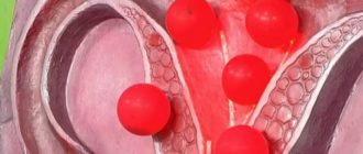 Узловая миома матки