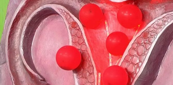 Узловая миома матки