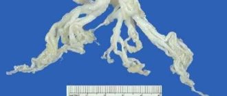 Мокрота cо слепками бронхов