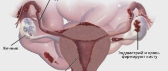 Эндометриоидные кисты обоих яичников, рецидив