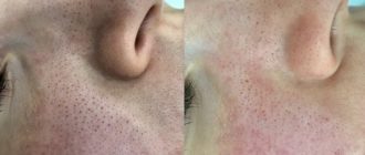 Воспаления после комплексной чистки лица