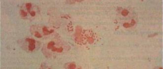 Диплококки, подозрение на гонорею