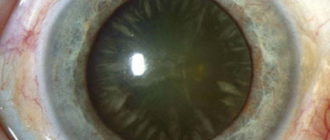 Начальная пресенильная катаракта