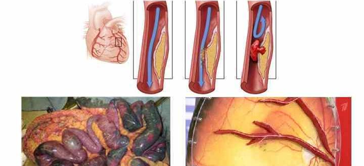 Нарушение кровотоков