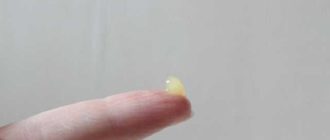 Выделения из анала