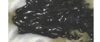 Черный кал при приеме Де-нол