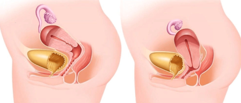 Возможно ли опущение матки при кручении обруча?