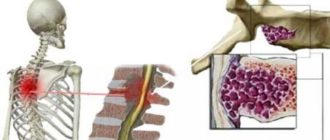 Что можно делать при грыжах позвоночника и гемангиоме