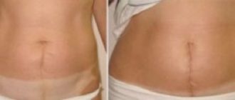 Можно беременеть с таким рубцом без метропластики?