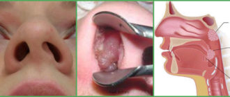 Вазомоторный ринитринит, киста