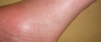 На ступне маленькие шарики по кожей, зудят и горят