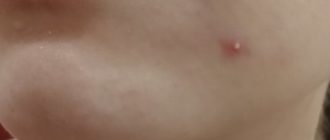 Единичные прыщи с белой головкой у девочки