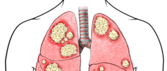 Метастазы саркомы в легкие, как облегчить дыхание