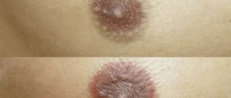 Вокруг соска выделение