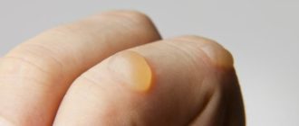 Волдыри на пальцах рук похожие на мозоли