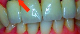 Волнует темное пятно на десне