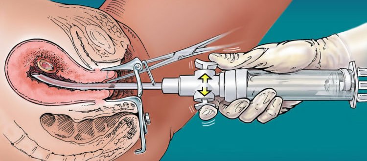 Возможна ли беременность если парень не помыл член и вставил