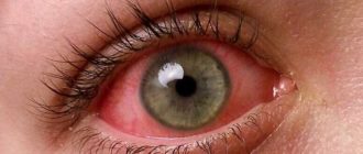 Вирусный Коньюктивит