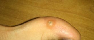 Воспаление после удаления занозы