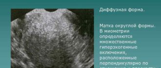 УЗ-признаки Диффузных изменений матки