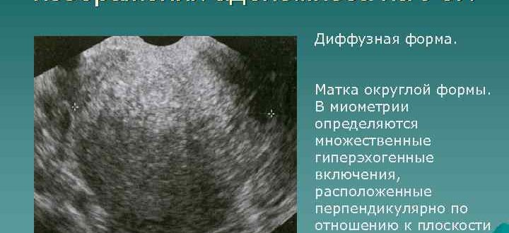УЗ-признаки Диффузных изменений матки