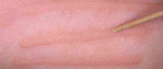 Чувствительность, вздутие кожи, плотное покраснения при трении, задевании