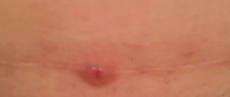 Воспалился шов