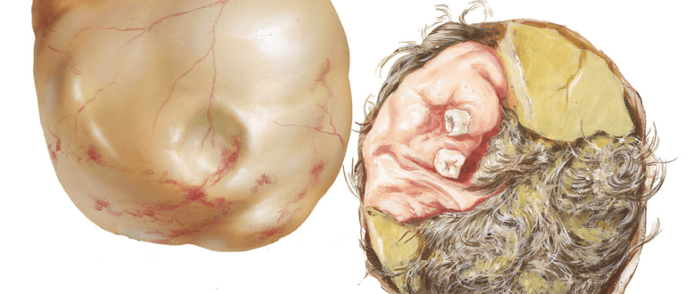 Дермоидная киста повторно