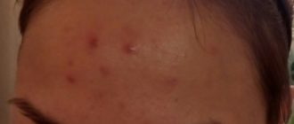 Выдавила прыщ на лбу и поднялась температура