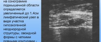 В аксиллярных областях определяются уплотнённые лимфоузлы до 1,3 см
