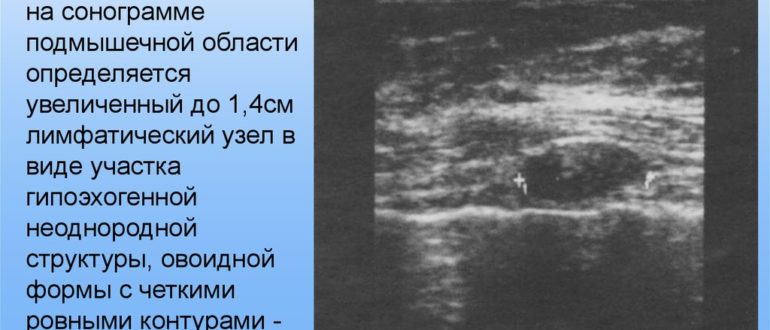 В аксиллярных областях определяются уплотнённые лимфоузлы до 1,3 см