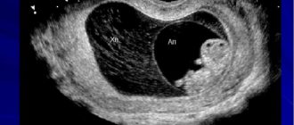 Элементы плодного яйца с кровоизлеяниями, никрозом. Что это?