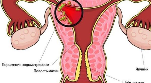 Дискомфорт в матке при оргазме