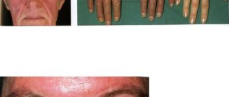 ДСТ, эритроцитоз