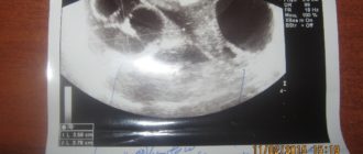 Доминантный фолликул или жёлтое тело?