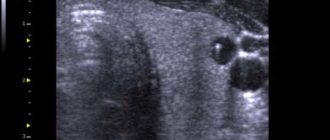 Узи признаки макрофолликулов и кисты левой доли