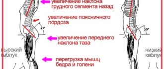 Можно ли носить каблуки, при грыжах позвоночника?
