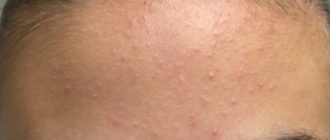 Много мелких прыщей на лице