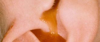 Выделения из уха при отите