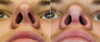 Деформация кончика носа после септопластики через год