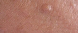 Водяные пузыри на мошонке