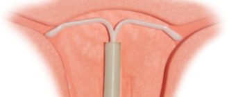 Можно ли ставить спираль вмс не рожавшим