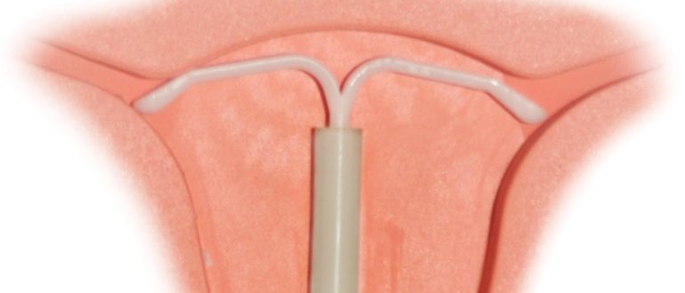 Можно ли ставить спираль вмс не рожавшим