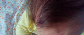 Впадинка на лбу ниже родничка на правой стороне