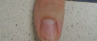 Дерматоскопия ногтевой пласттины