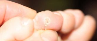 Наросты на мизинцах у ребенка