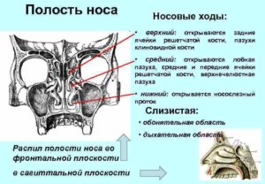 Вросшая ячейка решётчатой кости правой лобной пазухи