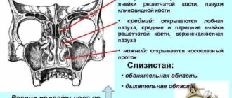 Вросшая ячейка решётчатой кости правой лобной пазухи